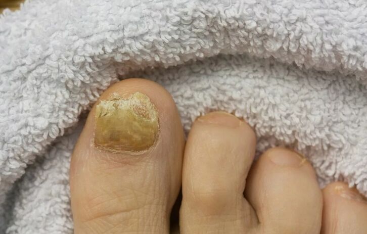 Hongo de uñas