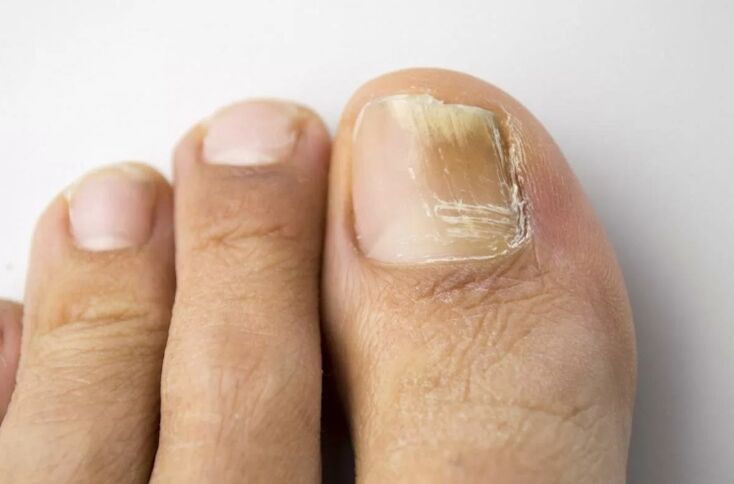 Micosis de la uña en la pierna