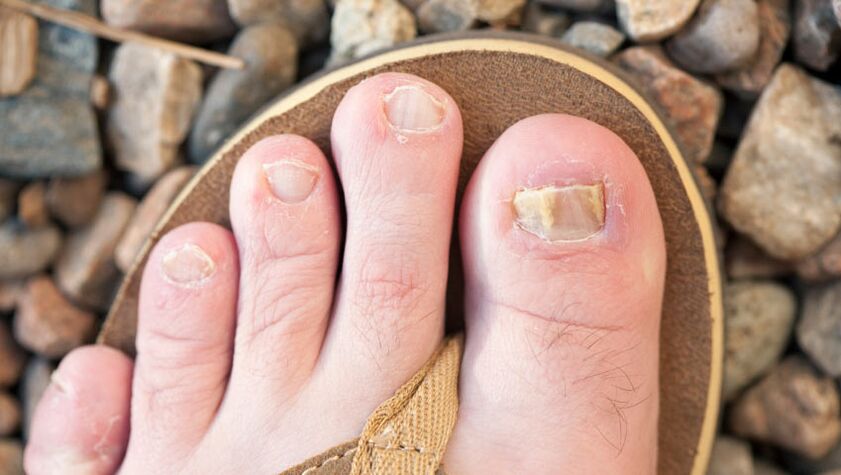 Onicomicosis de las uñas