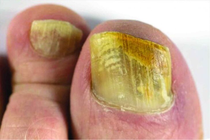 Sensación de uñas en la pierna
